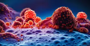 Entenda o que é câncer no estágio 4 e o que pode ser feito