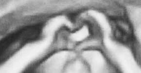 Bebê faz gesto de ‘coração’ em ultrassom