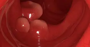 Alimento comum na cozinha do brasileiro reduz risco de câncer, diz estudo