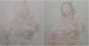 A mancha desta infiltração é semelhante à grávida de Taubaté