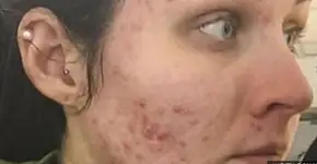Jovem desenvolve problema grave de acne da noite pro dia