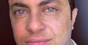 Thammy Miranda passa por procedimento para aumentar maxilar