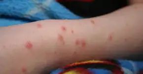 Varíola do macaco: transmissão sexual não pode estigmatizar homossexuais