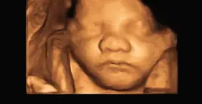 Bebida antes e durante gravidez causa alterações no rosto da criança