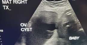 Exame revela que feto dividia o útero com um cisto gigante