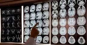 Testes com medicamento para Alzheimer têm resultado histórico