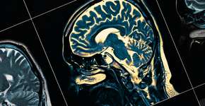 Estudo descobre novo sinal de Alzheimer em pacientes em estágio inicial