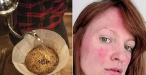 Beber café ajuda a suavizar rosácea, segundo estudo