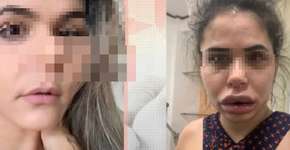 Dentista é acusada de deformar rosto de 40 mulheres após harmonização facial