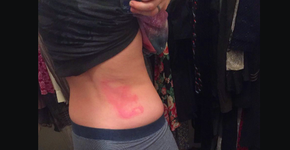 Capas de celular com glitter podem causar irritação e queimaduras