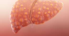 Este chá é muito eficiente em ajudar a controlar a gordura no fígado