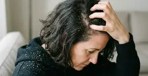 Acabe com a coceira: um método para tratar a caspa em casa