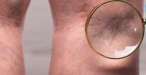 Por que o risco de trombose aumenta após trauma ou cirurgia?