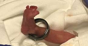 Foto de bebê prematuro com a aliança do pai causa comoção
