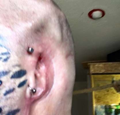 O inglês  mostra o resultado da cirurgia para remover as orelhas (Image: Reprodução/ The Daily Mail) 