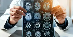 Sua alimentação pode proteger seu cérebro do Alzheimer