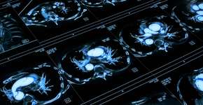 Dor de cabeça pode ser um sinal perigoso de aneurisma cerebral