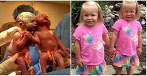 Com 2 anos, gêmeas que nasceram de mãos dadas continuam unidas