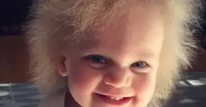 Condição rara: criança sofre com síndrome do cabelo impenteável