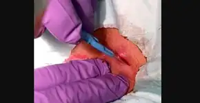 Médico filma momento de remoção de cisto e explosão de pus