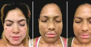 Tratamento inovador devolve o tom da pele de quem sofre vitiligo