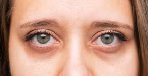 5 remédios naturais para acabar com as olheiras