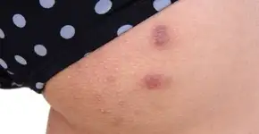 3 dicas essenciais para você se livrar das espinhas no bumbum