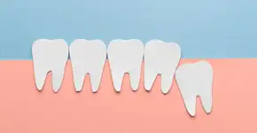 Dente do siso: por que algumas pessoas não têm?