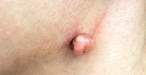 HPV: sintomas, causas e onde fazer o tratamento