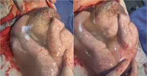 Em caso raríssimo, uma das gêmeas nasce dentro do saco gestacional