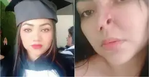 Alectomia: entenda a técnica de afinamento do nariz que deformou paciente