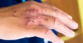 Surto de infecção no Complexo da Papuda afeta visitantes também