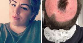 Mulher tem queimadura séria após tentar fazer cabelo de unicórnio