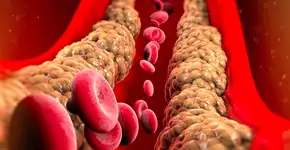 Nova injeção genética pode reduzir colesterol em até 69%