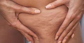 Saiba quais alimentos aumentam os furinhos da celulite