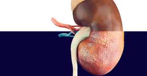 Quais alimentos aumentam a chance de desenvolver pedra nos rins?