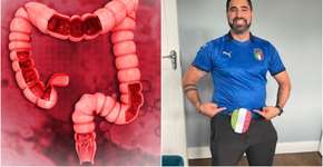 Foto: (reprodução/BowelCancer)