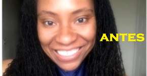 Blogueira vegana tem reação alérgica a henna no cabelo e mostra rosto desfigurado