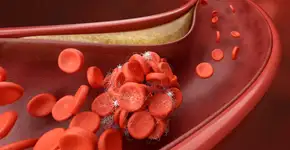 Como controlar o colesterol ruim?