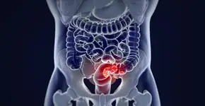 Câncer de intestino: alimento que todos tem em casa reduz risco da doença