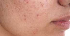 Pesquisadores descobrem a causa da acne adulta