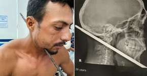 Homem sobrevive após ferro atravessar seu pescoço: ‘Sou um milagre’