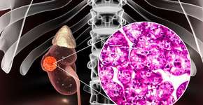 Câncer renal: sintomas silenciosos e fatores de risco que você precisa saber
