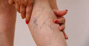 Por que as mulheres têm mais varizes? Entenda e saiba como prevenir