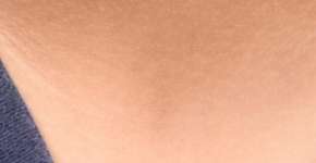 Manchas na pele podem ser diabetes