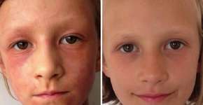 Fotógrafa cura doença de pele da filha através da alimentação