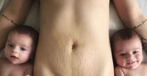 Puérpera posta foto de estrias e marca de cesárea e viraliza