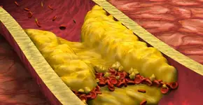 É possível controlar o colesterol ruim?