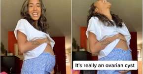 Jovem viraliza no TikTok ao mostrar cisto no ovário que parece gravidez
