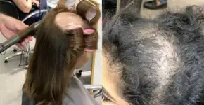 Noivas com calvície ganham penteados incríveis que cobrem falhas